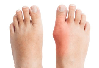 pair-of-feet-with-deformed-right-toe-due-to-painful-gout