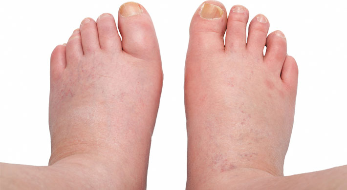 two-swollen-feet