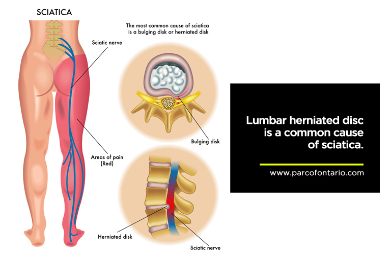 Sciatica VS Sciatic Pain