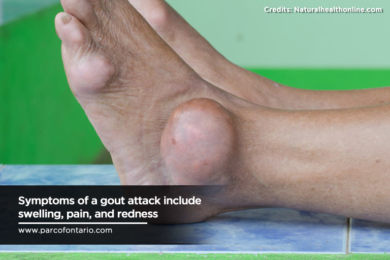 gout attack swelling, pain, and redness