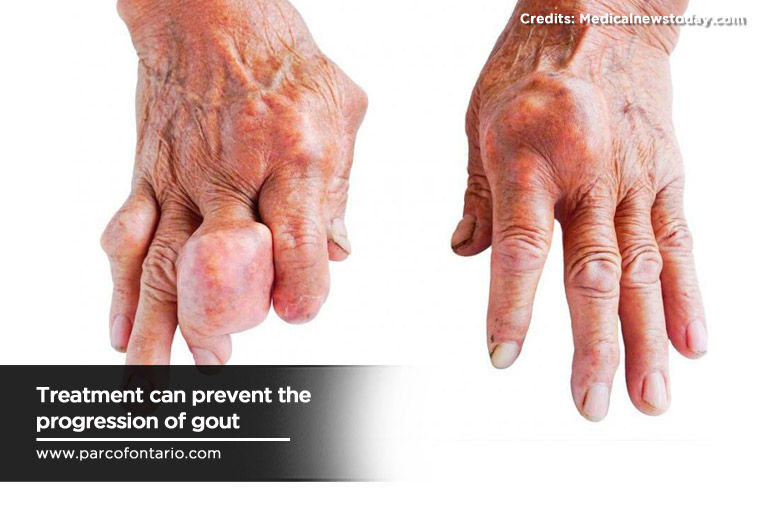 Treatment can prevent the progression of gout