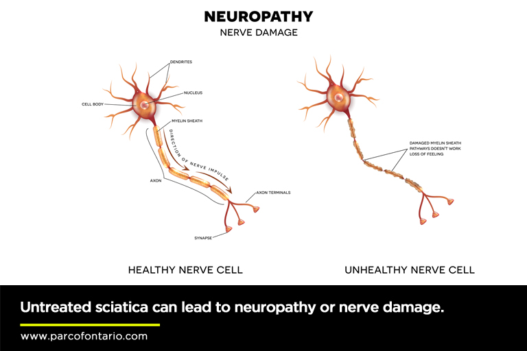 Untreated-sciatica-can-lead-to-neuropathy-or-nerve-damage