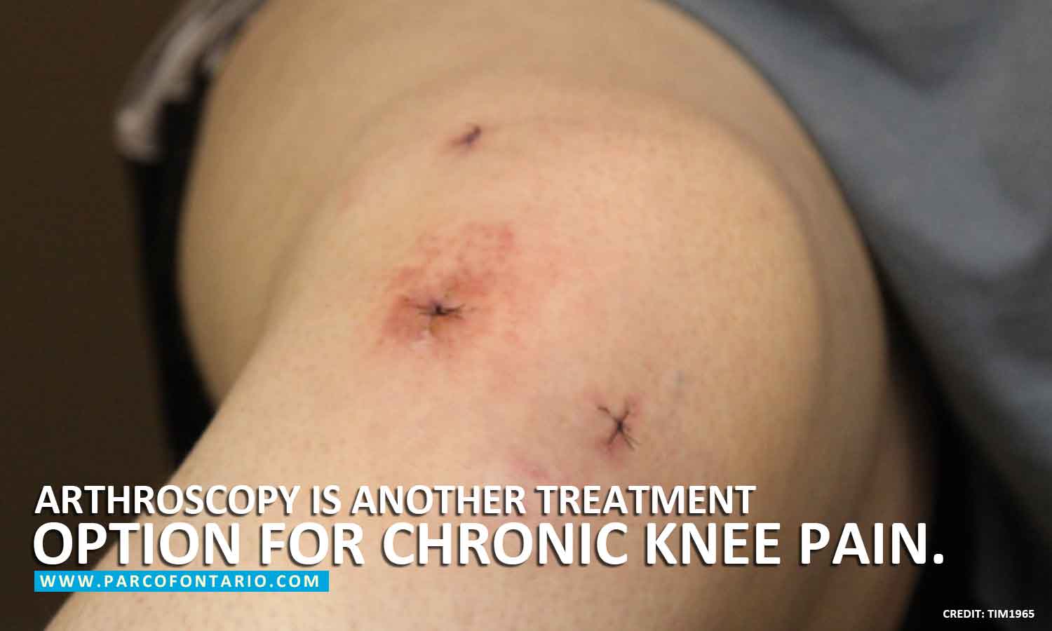  Arthroscopy is another treatment option