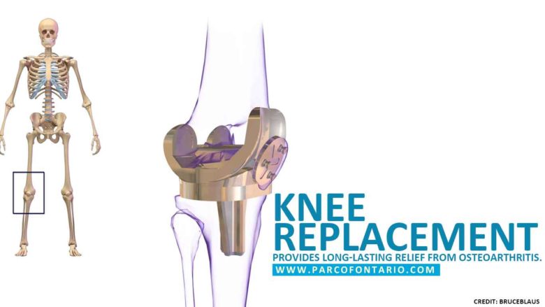 Knee replacement provides long-lasting relief