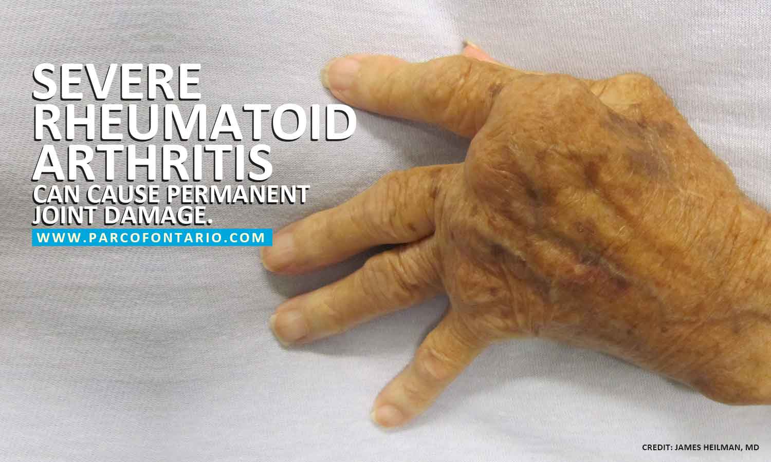 rheumatoid arthritis can cause permanent joint damage
