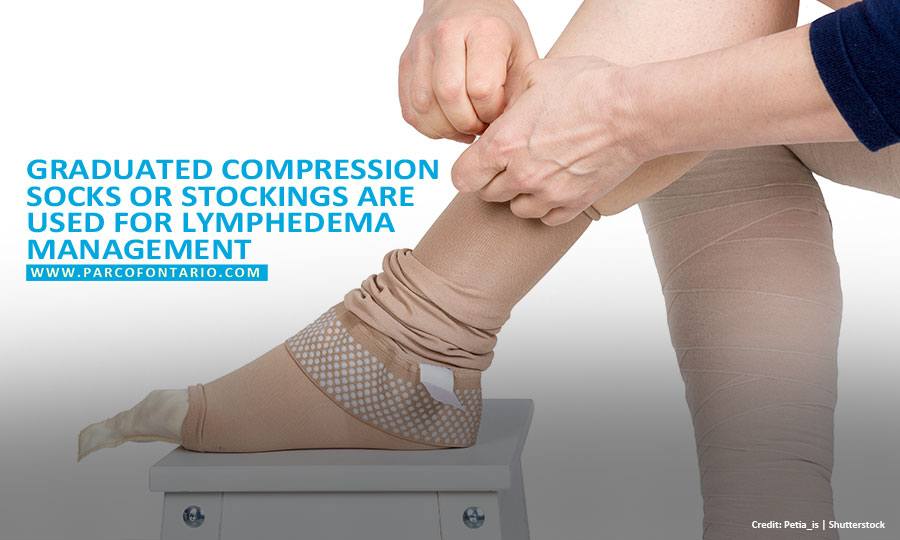  Graduated compression socks or stockings are used for lymphedema management