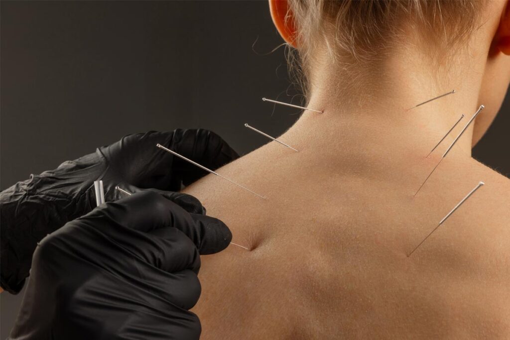 How-Acupuncture-Points-Are-Used-in-Practice