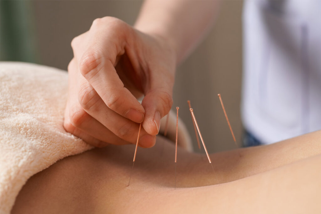Can-Acupuncture-Help-with-Pain-That-Has-Lasted-for-Decades